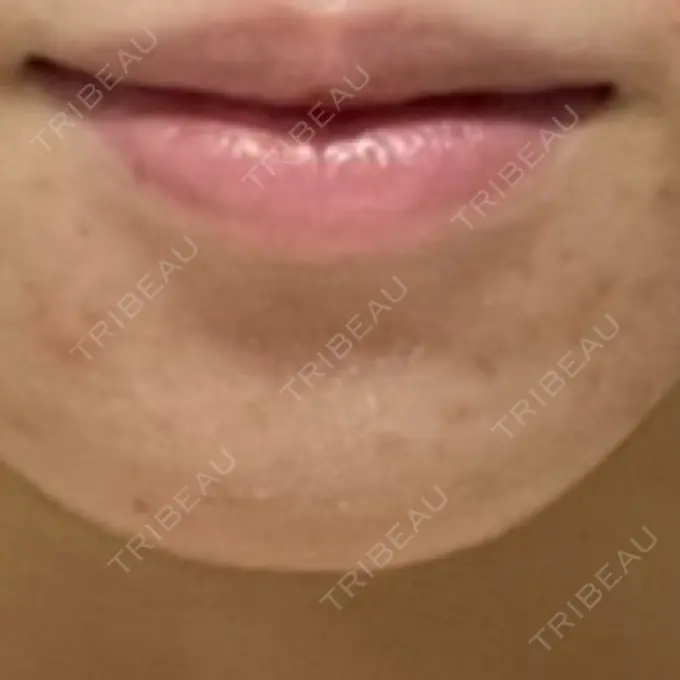 ボトックス（あご） / ヒアルロン酸注入（あご） / ヒアルロン酸注入（鼻翼基部） ジョウクリニック 大阪院 BEFORE メイン用