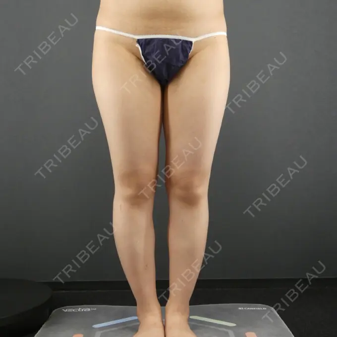 脂肪吸引（脚） GRACIA clinic 【グラシアクリニック】 BEFORE メイン用