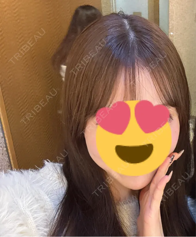 ヒアルロン酸溶解 EOL CLINIC【オルクリニック】 BEFORE メイン用