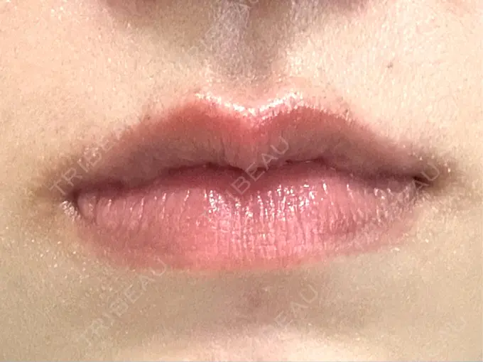 ヒアルロン酸注入（唇） 目白ホワイトクリニック BEFORE メイン用