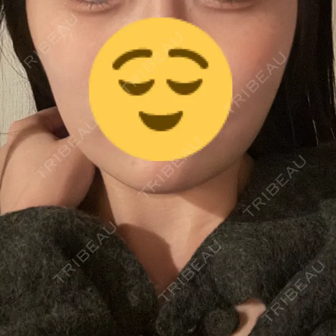 脂肪吸引（顔） / 脂肪吸引注射（顔） ziz CLINIC BEFORE メイン用