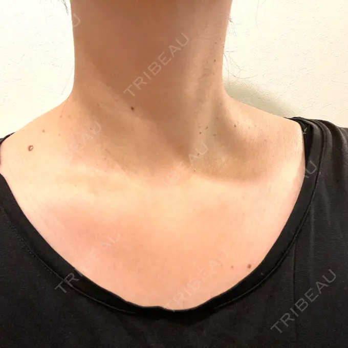 ほくろ・いぼ切除（肌） Kobe OCEANS Clinic BEFORE メイン用