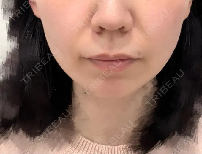 ヒアルロン酸注入（鼻翼基部） Brandnew Beauty Clinic BEFORE メイン用