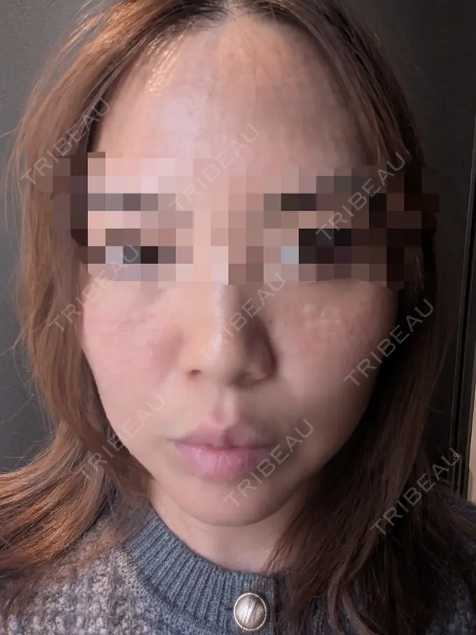 肌ヒアルロン酸注入（たるみ・シワ改善） / 水光注射（ハリ・美肌） / RF（高周波）たるみ治療 AB美容クリニック 新宿院 BEFORE メイン用