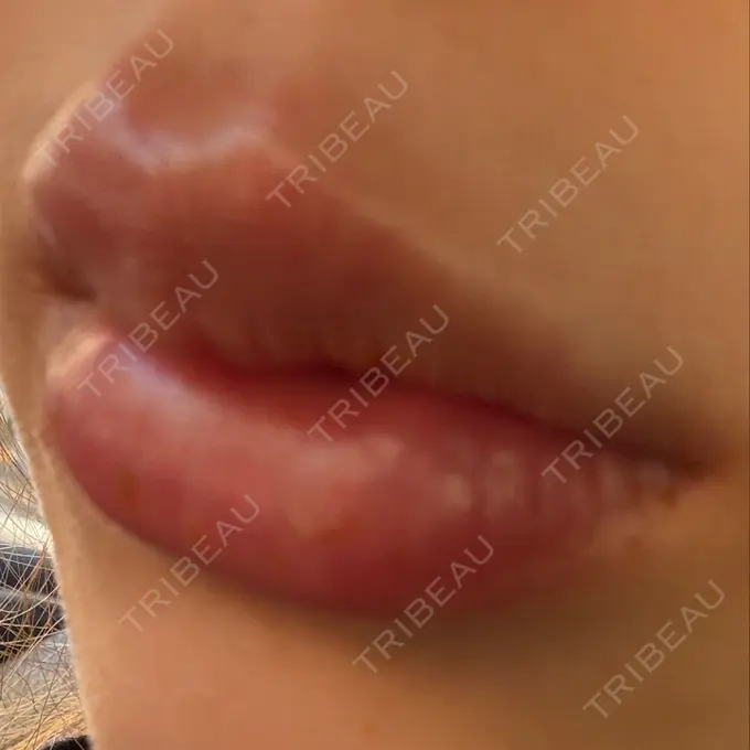 ヒアルロン酸注入（唇） 小倉美容外科/美容皮膚科 ビラビューティークリニック BEFORE メイン用