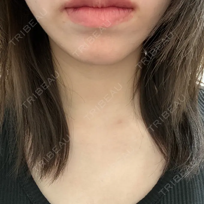 ヒアルロン酸注入（唇） 新未来クリニック BEFORE メイン用