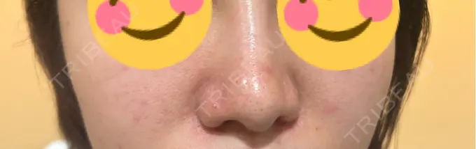 イオン導入 / 毛穴洗浄（ハイドラフェイシャルなど） / ピコレーザートーニング（美白・肝斑） 表参道ウィズ・クリニック BEFORE メイン用