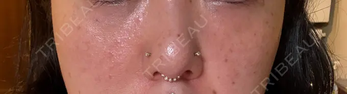 マイクロボトックス Natural Skin Clinic 自由ヶ丘院 BEFORE メイン用