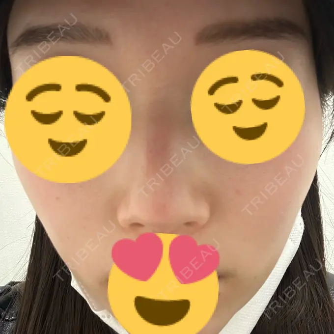 ピーリング（ニキビ・毛穴） First Clinic BEFORE メイン用