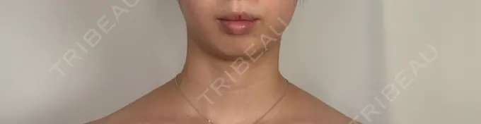 ヒアルロン酸注入（あご） / ヒアルロン酸注入（唇） アリエル美容クリニック 水戸院 BEFORE メイン用