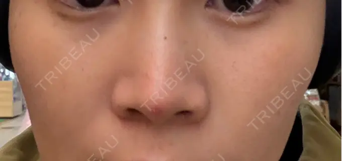 ルメッカ MIO CLINIC 梅田院 BEFORE メイン用