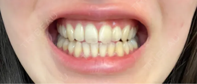 ホワイトニング 銀座本院 歯と美容のクリニック BEFORE メイン用