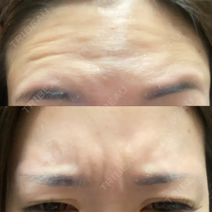 ボトックス（眉間） / ボトックス（額） / エレクトロポレーション / 光治療（フォトフェイシャルなど） / ルメッカ BITO BEAUTY CLINIC BEFORE メイン用