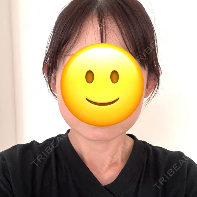 ボトックス（エラ・小顔） 共立美容外科 神戸三宮院 BEFORE メイン用