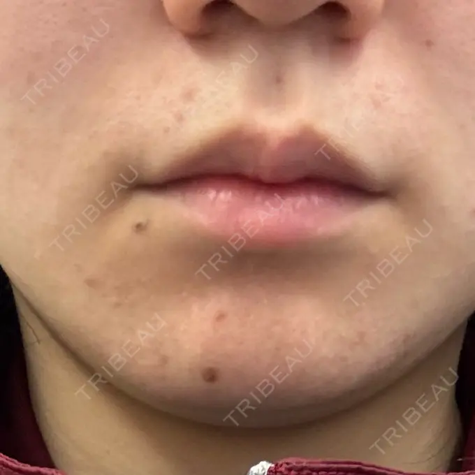 インモード 東京シルククリニック 東京神田院 BEFORE メイン用