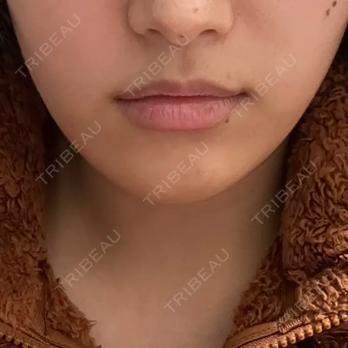 ヒアルロン酸注入（涙袋） / ヒアルロン酸注入（鼻） / ヒアルロン酸注入（唇） / ヒアルロン酸注入（頬） HAAB×DREAM BEAUTY CLINIC 大阪梅田院 BEFORE メイン用