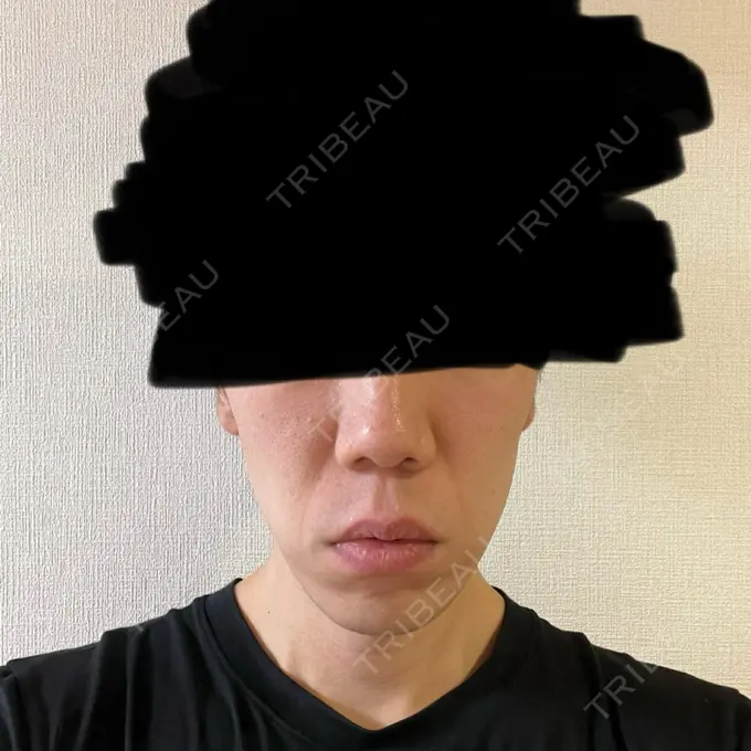 糸リフト / 脂肪吸引（顔） 東京ココセランクリニック BEFORE メイン用