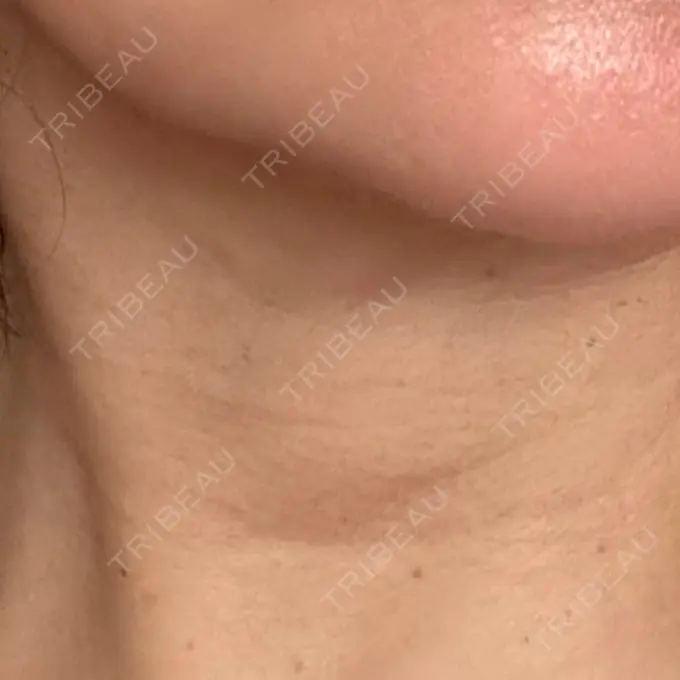 ヒアルロン酸注入（首） MKクリニック 銀座院 BEFORE メイン用