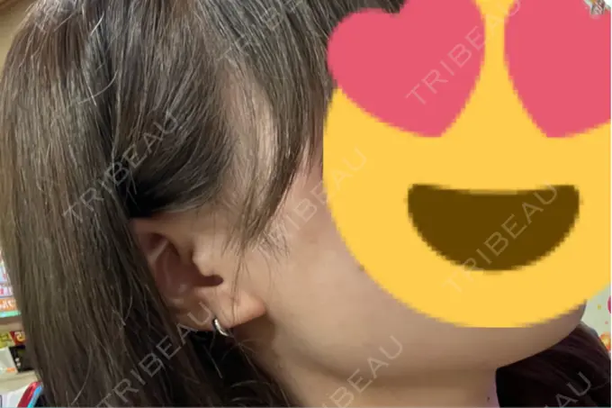 ヒアルロン酸注入（あご） / ボトックス（エラ・小顔） / ボトックス（口角） DMTC CLINIC 日本橋院 BEFORE メイン用