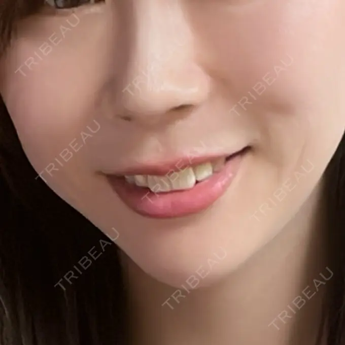 ヒアルロン酸注入（頬） / ヒアルロン酸注入（鼻翼基部） HAAB×DREAM BEAUTY CLINIC 大阪梅田院 BEFORE メイン用