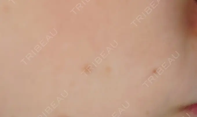 ほくろ・いぼ切除（肌） 札幌中央クリニック BEFORE メイン用