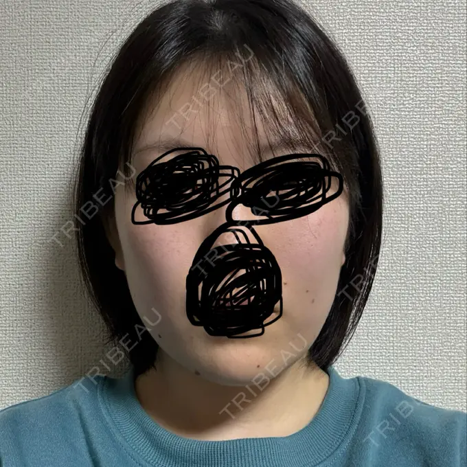 糸リフト / 脂肪吸引（顔） 東京ココセランクリニック BEFORE メイン用