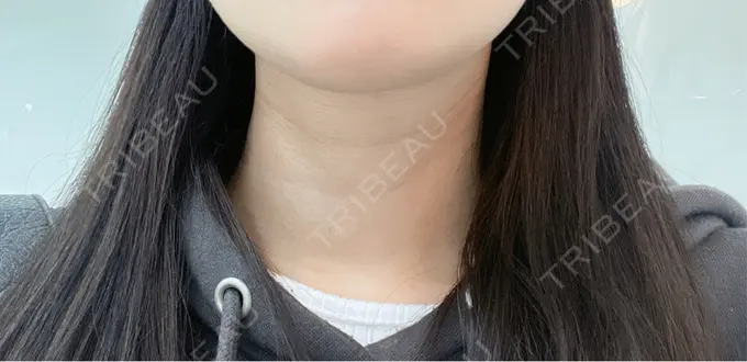 ヒアルロン酸注入（首） 銀座TSUBAKIクリニック BEFORE メイン用