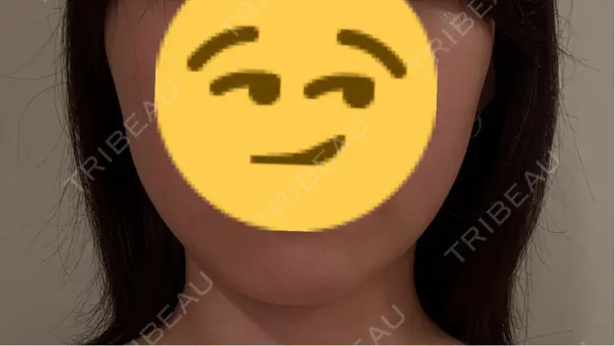 オンダリフト RIVER CLINIC（リバークリニック） BEFORE メイン用