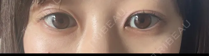 ヒアルロン酸注入（涙袋） フィラークリニック 名古屋栄院 BEFORE メイン用