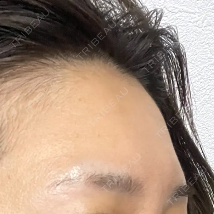 ボトックス（口角） / ボトックス（眉間） / ボトックス（額） / ボトックス（バニーライン） DMTC美容皮膚科 大宮院 BEFORE メイン用