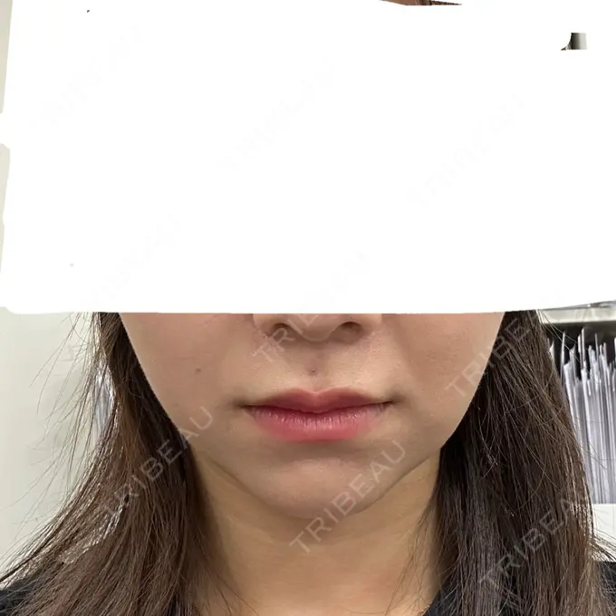 糸リフト / 脂肪吸引（顔） / ほくろ・いぼ除去レーザー（肌） 横浜TAクリニック BEFORE メイン用