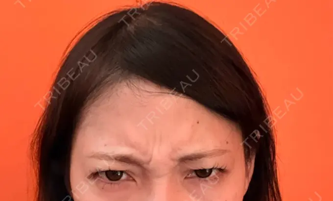 ボトックス（眉間） / ピーリング（ニキビ・毛穴） / 光治療（フォトフェイシャルなど） おおたかの森ビューティークリニック BEFORE メイン用