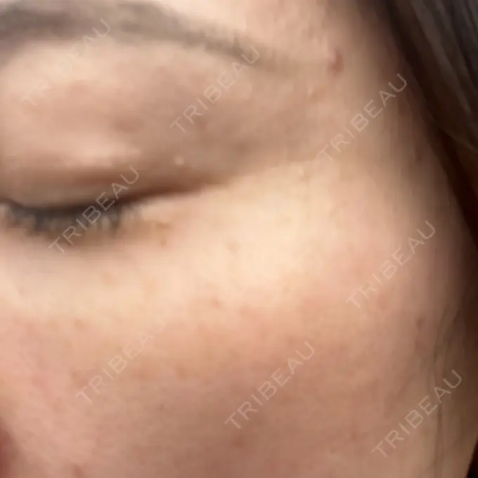 ほくろ・いぼ切除（肌） ルラ美容クリニック 東京駅前院 BEFORE メイン用