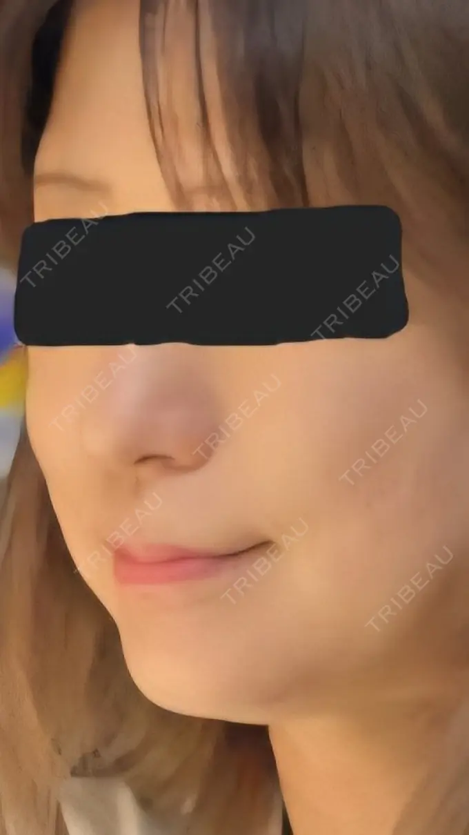 糸リフト / ショッピングリフト BAO CLINIC 神戸院 BEFORE メイン用