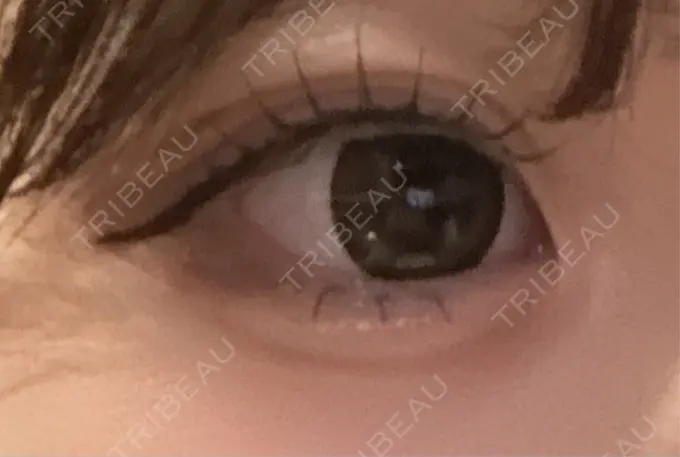 ヒアルロン酸注入（涙袋） フィラークリニック 名古屋栄院 BEFORE メイン用