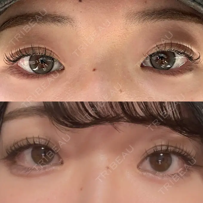 ヒアルロン酸注入（涙袋） フィラークリニック 名古屋栄院 BEFORE メイン用