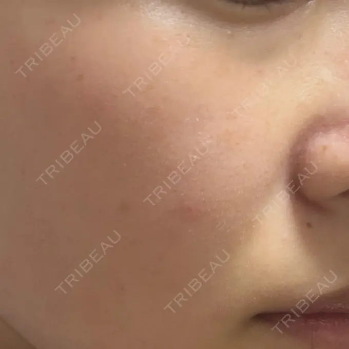 エレクトロポレーション / 毛穴洗浄（ハイドラフェイシャルなど） 表参道ウィズ・クリニック BEFORE メイン用