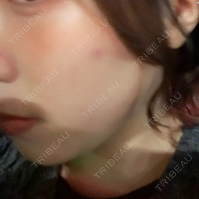 医療脱毛（顔） ZX-CLINIC BEFORE メイン用