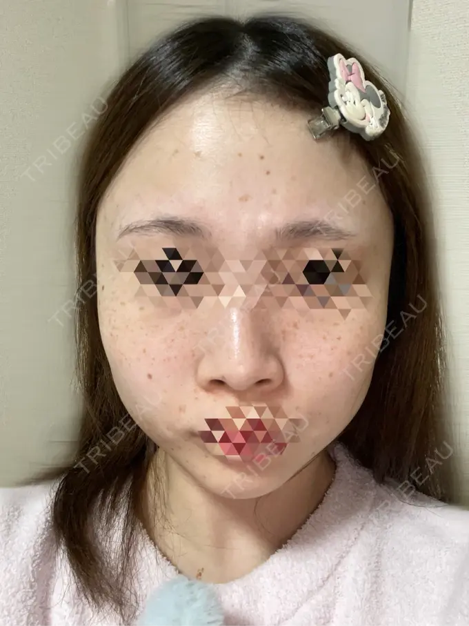 ほくろ・いぼ切除（肌） 東京シルククリニック 新宿院 BEFORE メイン用