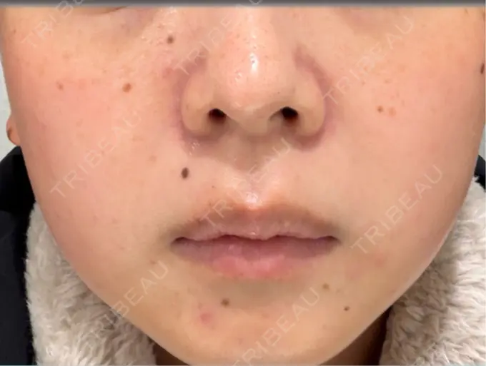 イオン導入 / ピーリング（ハリ・ツヤ） / ルメッカ ルラ美容クリニック 仙台院 / ルラスキンクリニック 仙台院 BEFORE メイン用