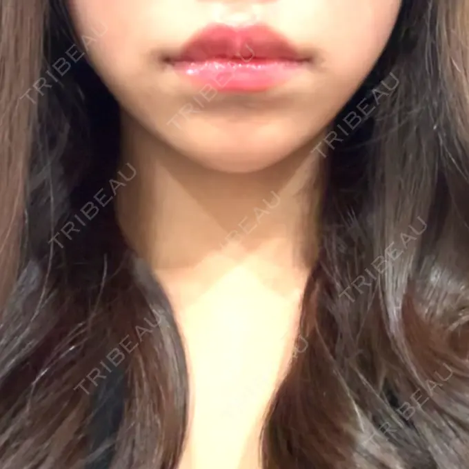 ヒアルロン酸注入（あご） / ヒアルロン酸注入（唇） アリエル美容クリニック 水戸院 BEFORE メイン用