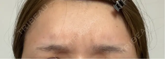 ボトックス（あご） / ボトックス（口角） / ボトックス（肩） / ボトックス（眉間） / ボトックス（首） DMTC CLINIC 日本橋院 BEFORE メイン用