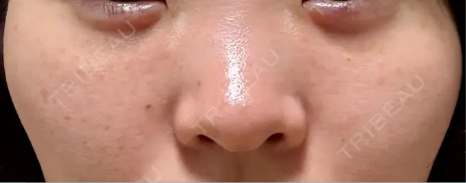 ピコレーザートーニング（美白・肝斑） BISIN GINZA CLINIC BEFORE メイン用