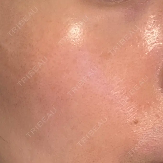 LDM・インテンスウルトラ 品川スキンクリニック広島院 BEFORE メイン用