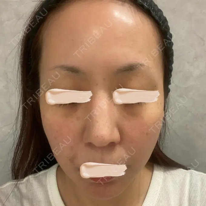 ピーリング（ニキビ・毛穴） / LDM・インテンスウルトラ Chloe Cheongdam Clinic （クロエチョンダムクリニック） BEFORE メイン用