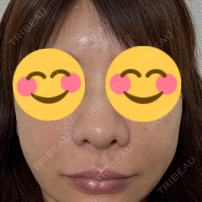 ピーリング（ハリ・ツヤ） Sea Sail Beauty Clinic BEFORE メイン用