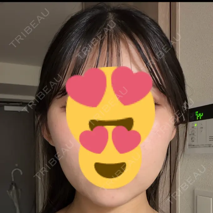 ボトックス（エラ・小顔） 湘南美容クリニック 大阪四ツ橋院 BEFORE メイン用