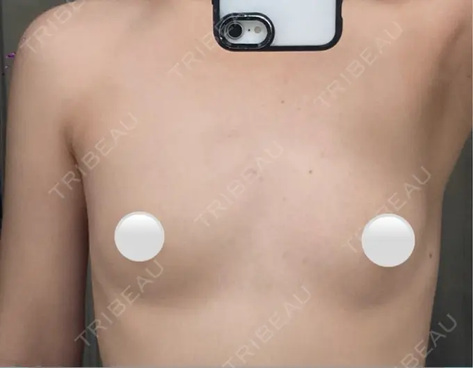 豊胸（脂肪注入） ルーチェクリニック 銀座院 BEFORE メイン用