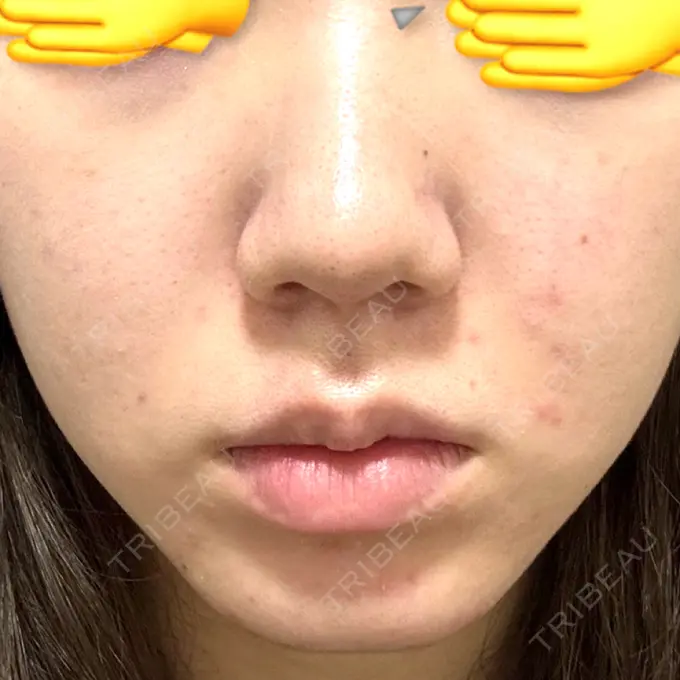 医療脱毛（顔） おおかみ美容のクリニック 横浜院 BEFORE メイン用