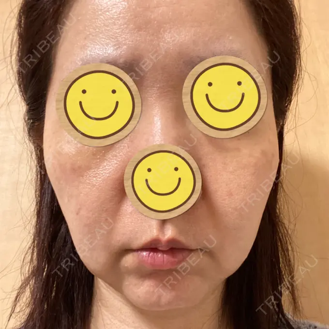 医療脱毛（顔） S-Laboクリニック 渋谷院 BEFORE メイン用